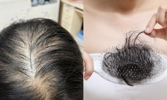 Hành trình chữa rụng tóc