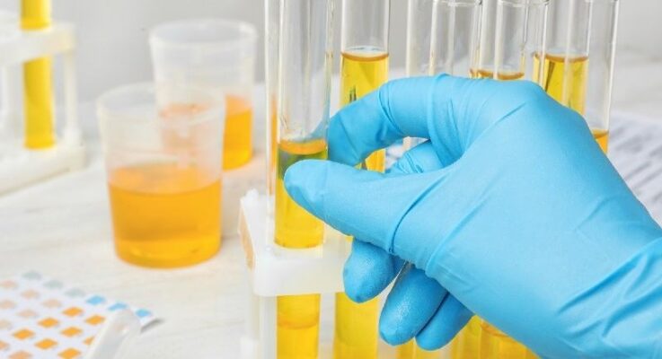 Xét nghiệm nước tiểu bao nhiêu tiền? Tìm hiểu chi phí và quy trình 19 Chẩn đoán bệnh lý