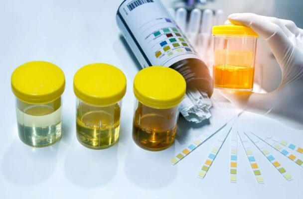 Xét nghiệm nước tiểu bao nhiêu tiền? Tìm hiểu chi phí và quy trình 18 Theo dõi bệnh tật