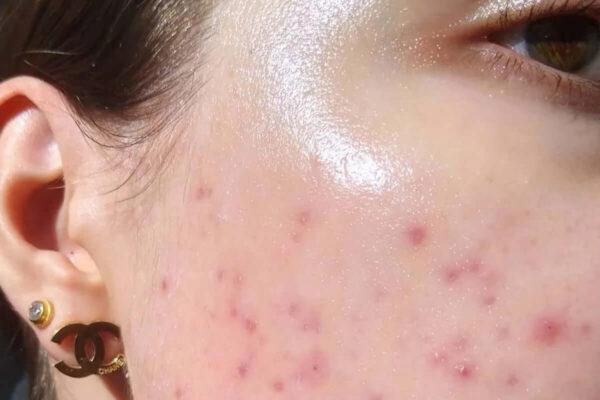 Tránh sử dụng khi da bị tổn thương