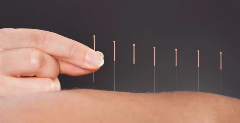 Chăm sóc sức khỏe bằng y học cổ truyền - Kết hợp đông tây y hiện đại 21 Châm cứu
